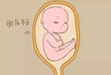 胎位不正的風險及矯正方法-寶寶俱樂部