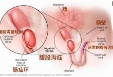 2歲寶寶因它終身無法生育：這個能要命的病，千萬要當心-寶寶俱樂部